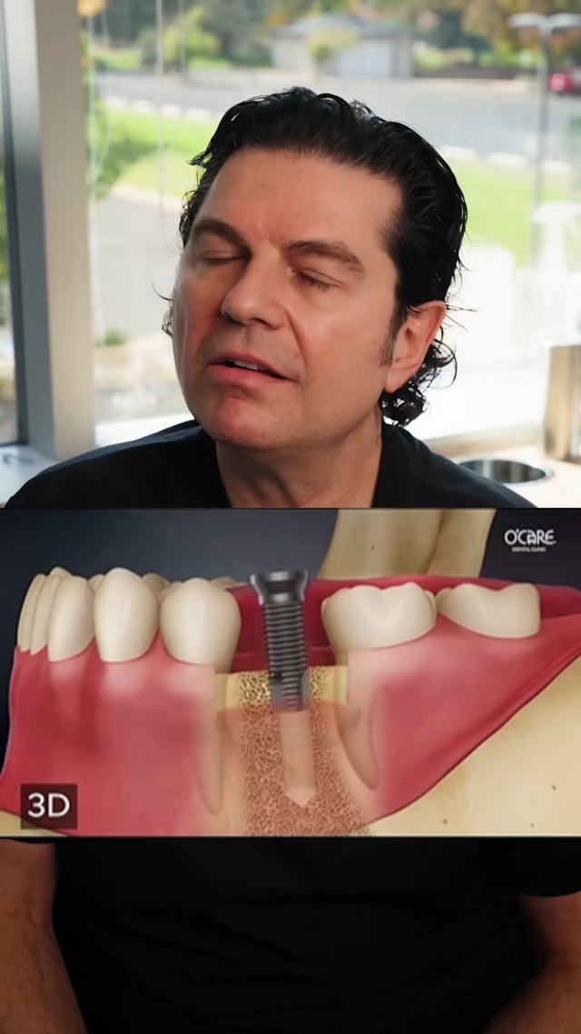 How Long Does An Implant Last