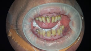 Upper & Lower All-on-4: Severe perio, implant removal, bleeding management.