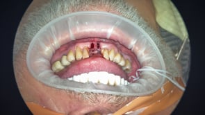Lower All-on-4, Challenging Posterior Extractions