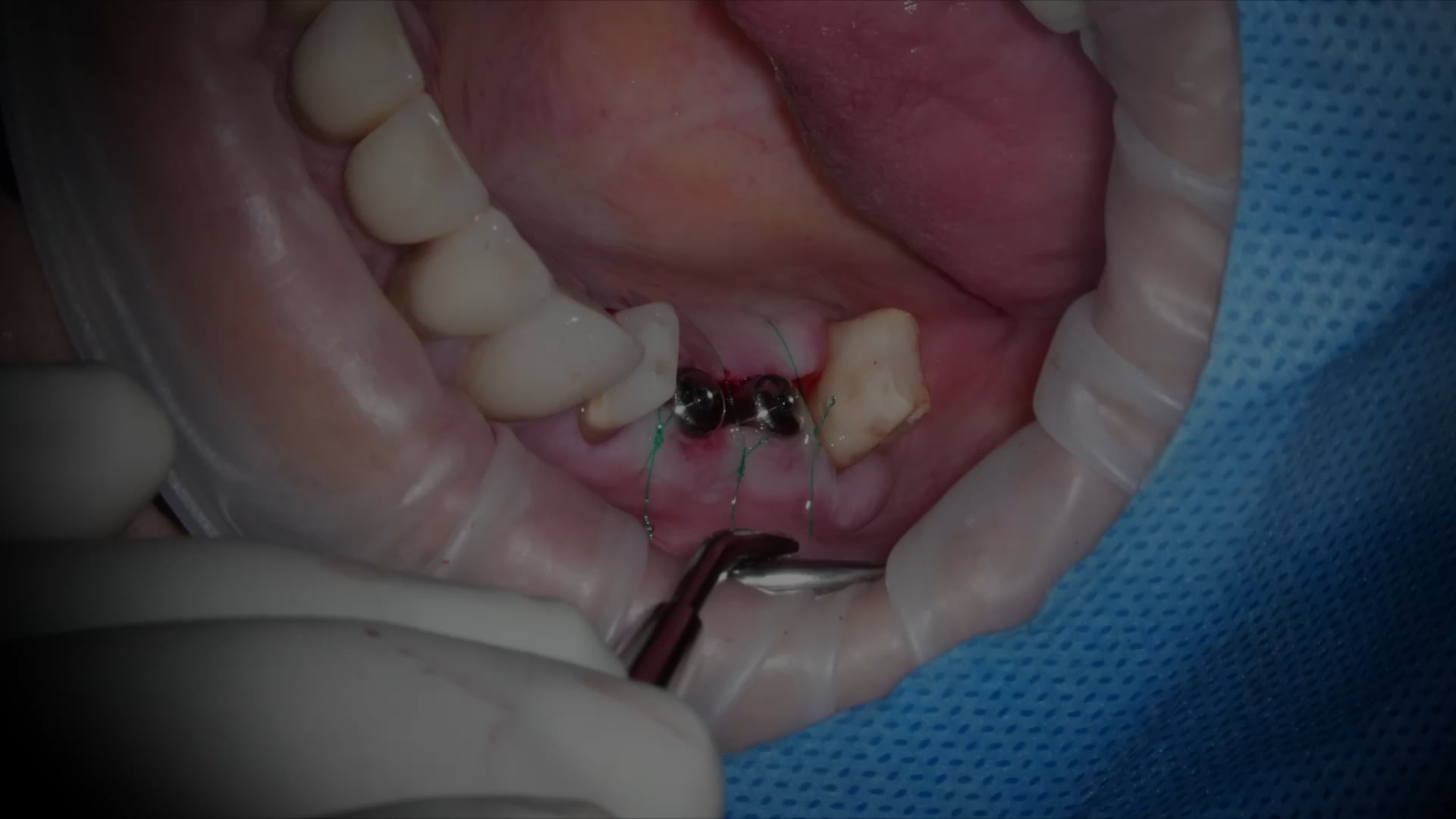 【GPB_implant_up2_040】縫合