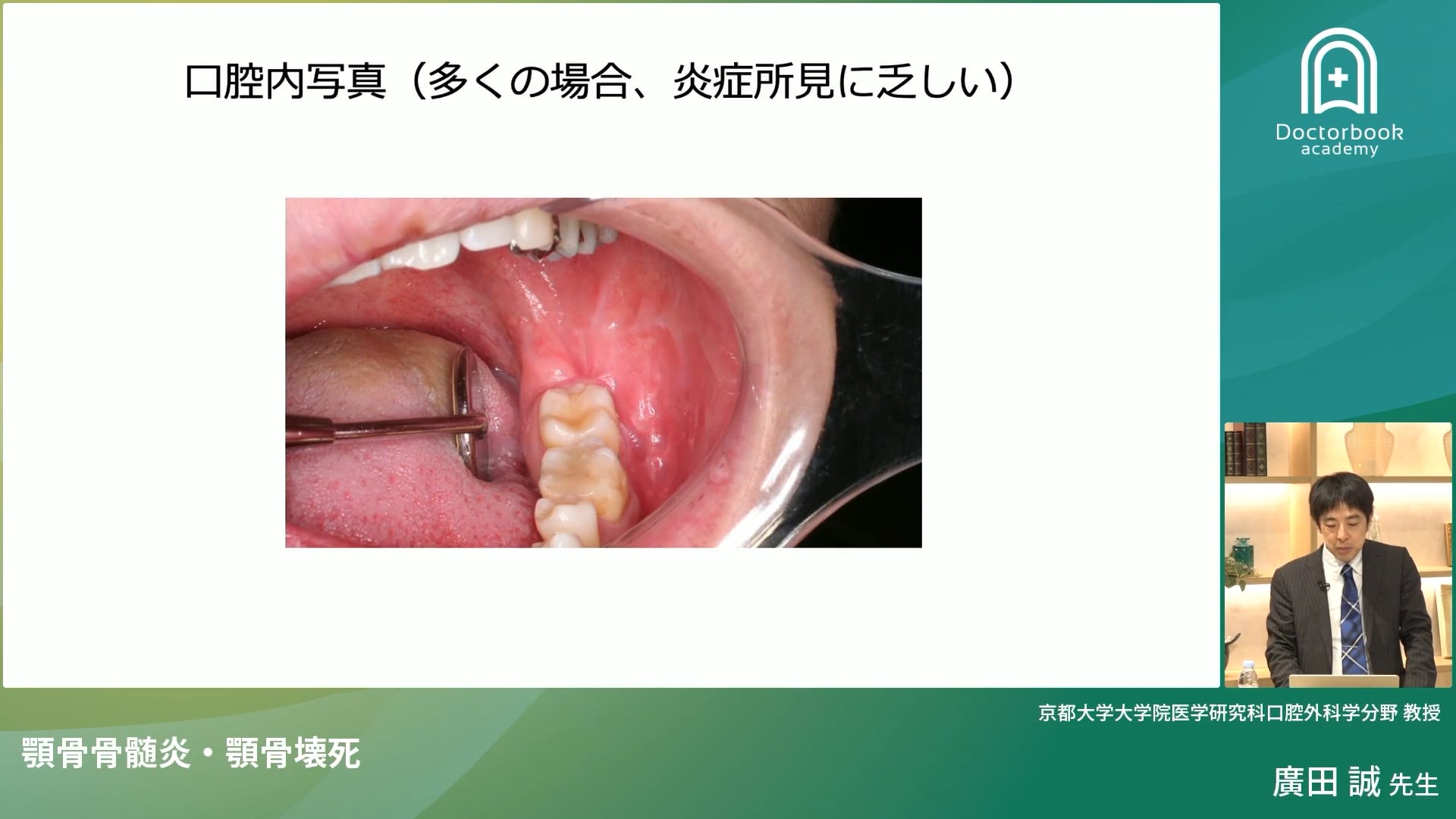 臨床知見録_顎骨壊死_慢性下顎骨骨髄炎の臨床症例