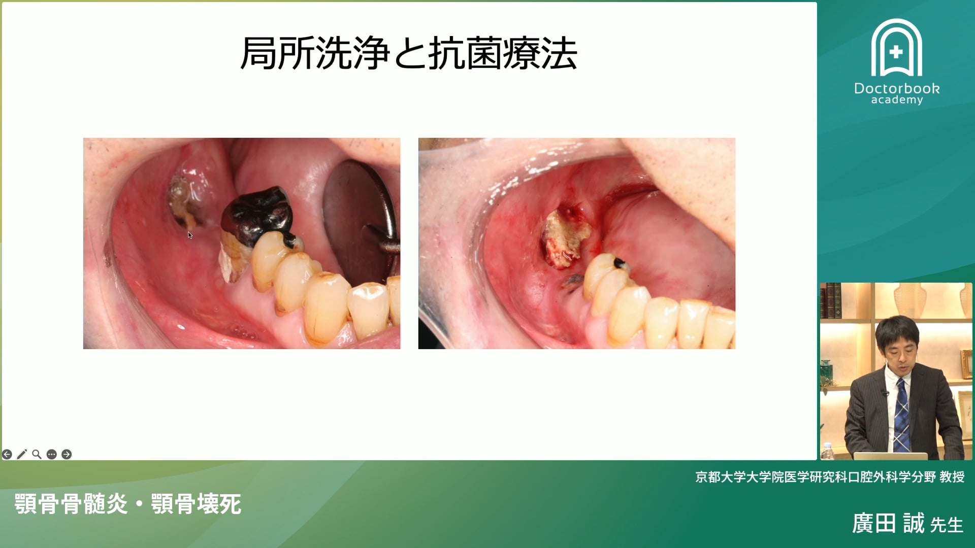 臨床知見録_顎骨壊死_顎骨壊死の臨床症例