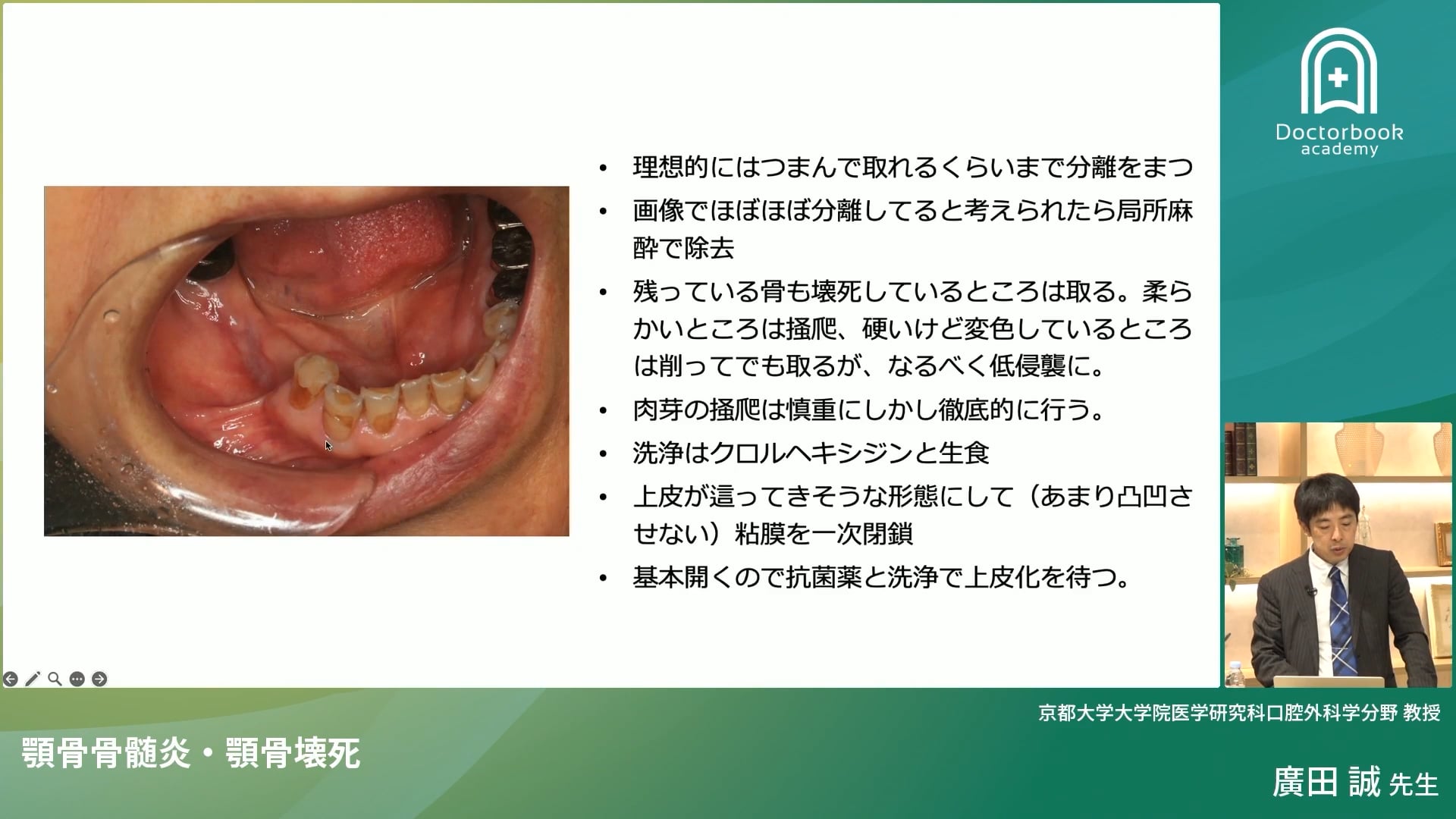 臨床知見録_顎骨壊死_顎骨壊死の外科処置時のまとめ