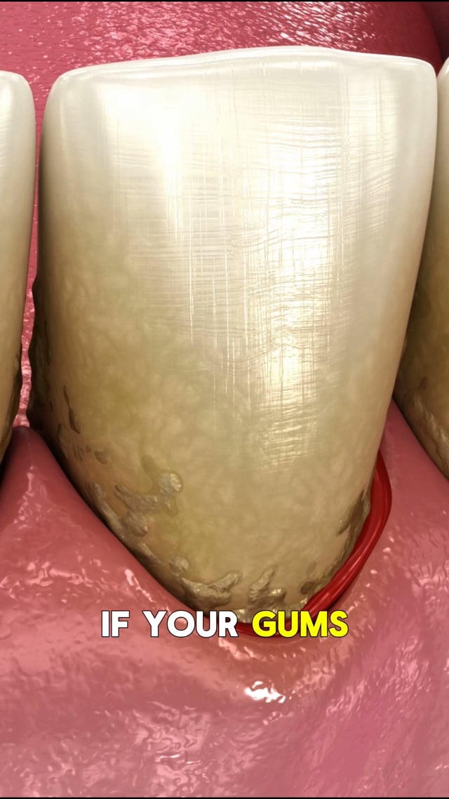 Bleeding Gums