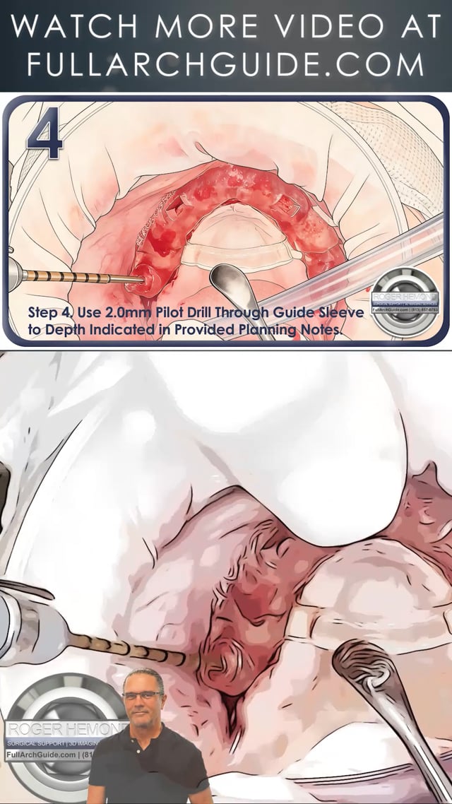 Step by Step Guided Pterygoid Implant Placement