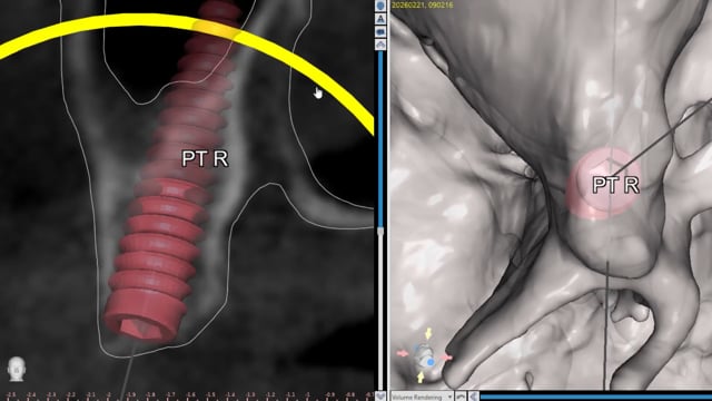 The Greater Palatine Artery in Relation to Pterygoid Implant Placement