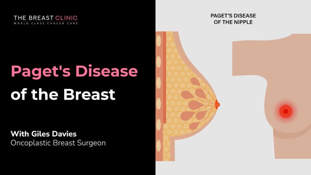 Paget's Disease of the Breast