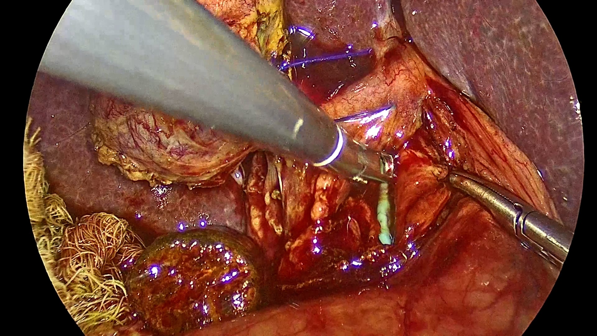 Laparoscopic cholecystectomy and bile duct revision