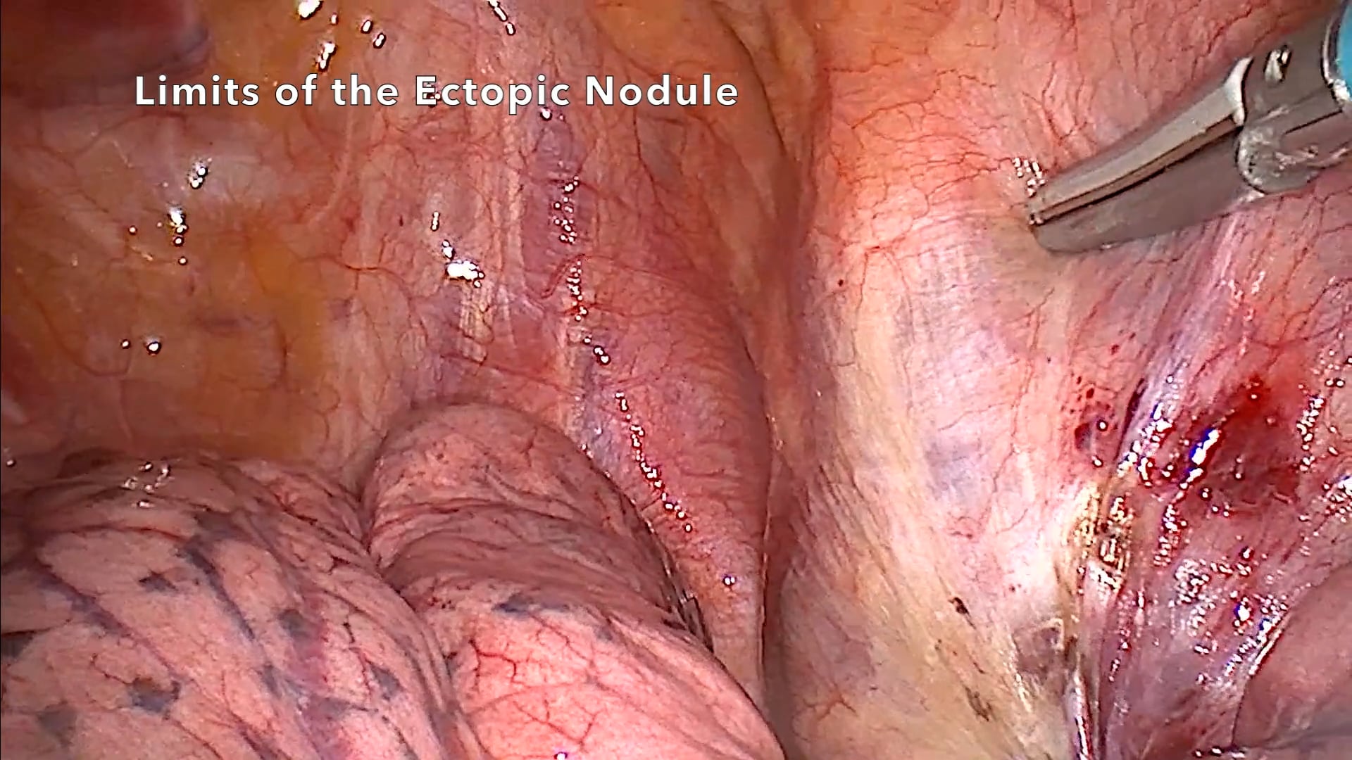 Video-assisted thoracoscopic surgery (VATS) for an intrathoracic ectopic thyroid nodule