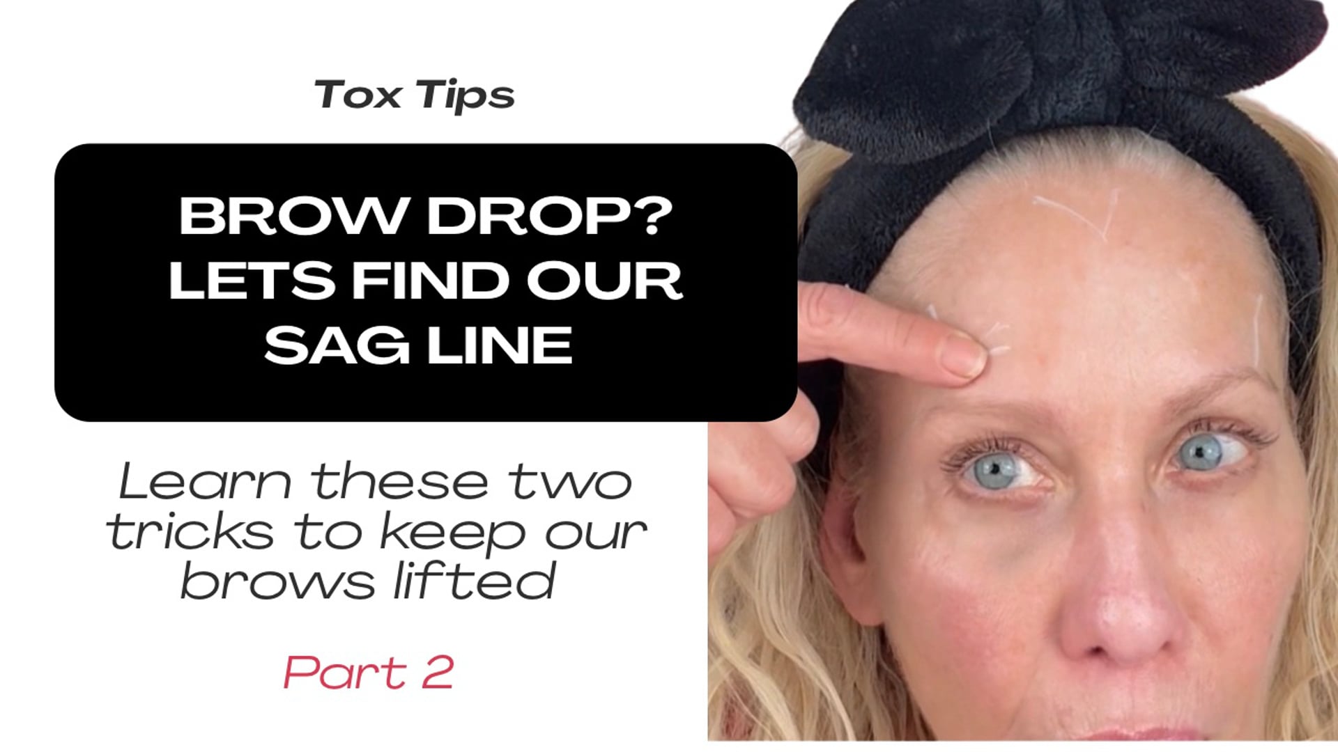 Part 2: Brow Lift or Brow Drop? Let’s find our Sag Line
