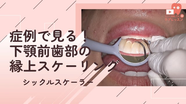 04.症例で見る！下顎前歯部の縁上スケーリング