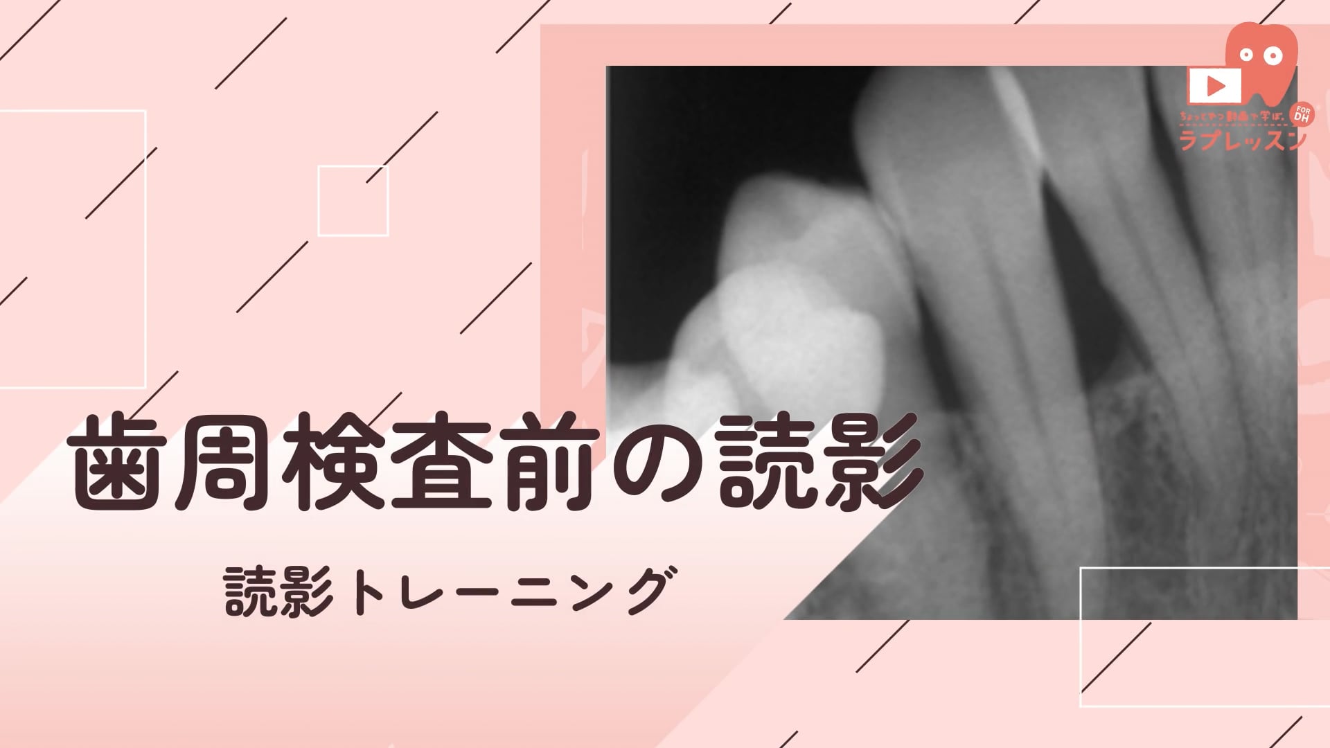 10.歯周検査前の読影