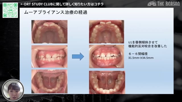 第38回 7歳男児の反対咬合症例｜過剰歯・口呼吸を伴う小児矯正