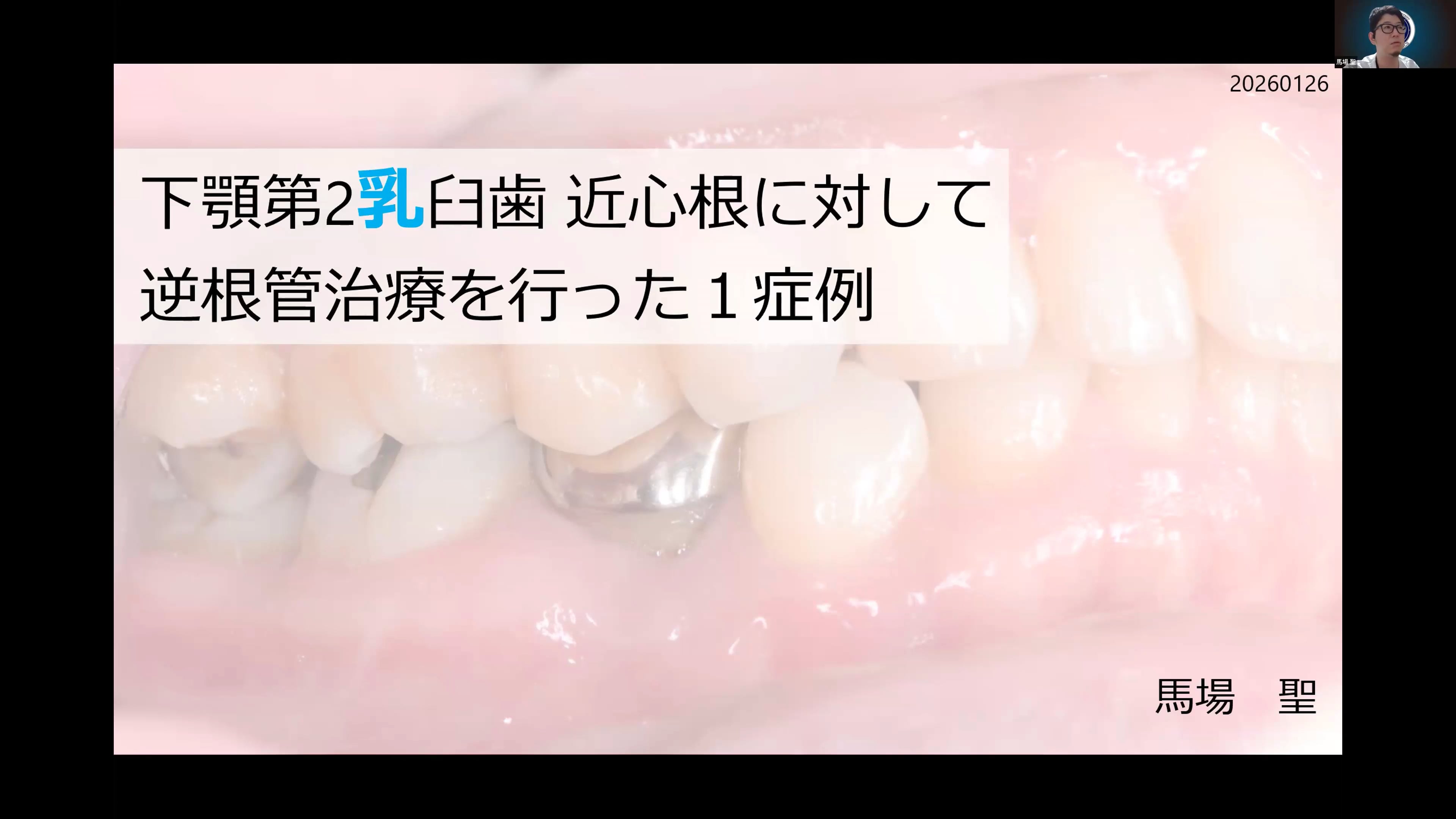 下顎第2乳臼歯 近心根に対して逆根管治療を行った1症例｜馬場 聖先生(Topics)