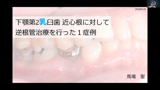 下顎第2乳臼歯 近心根に対して逆根管治療を行った1症例｜馬場 聖先生(Topics)