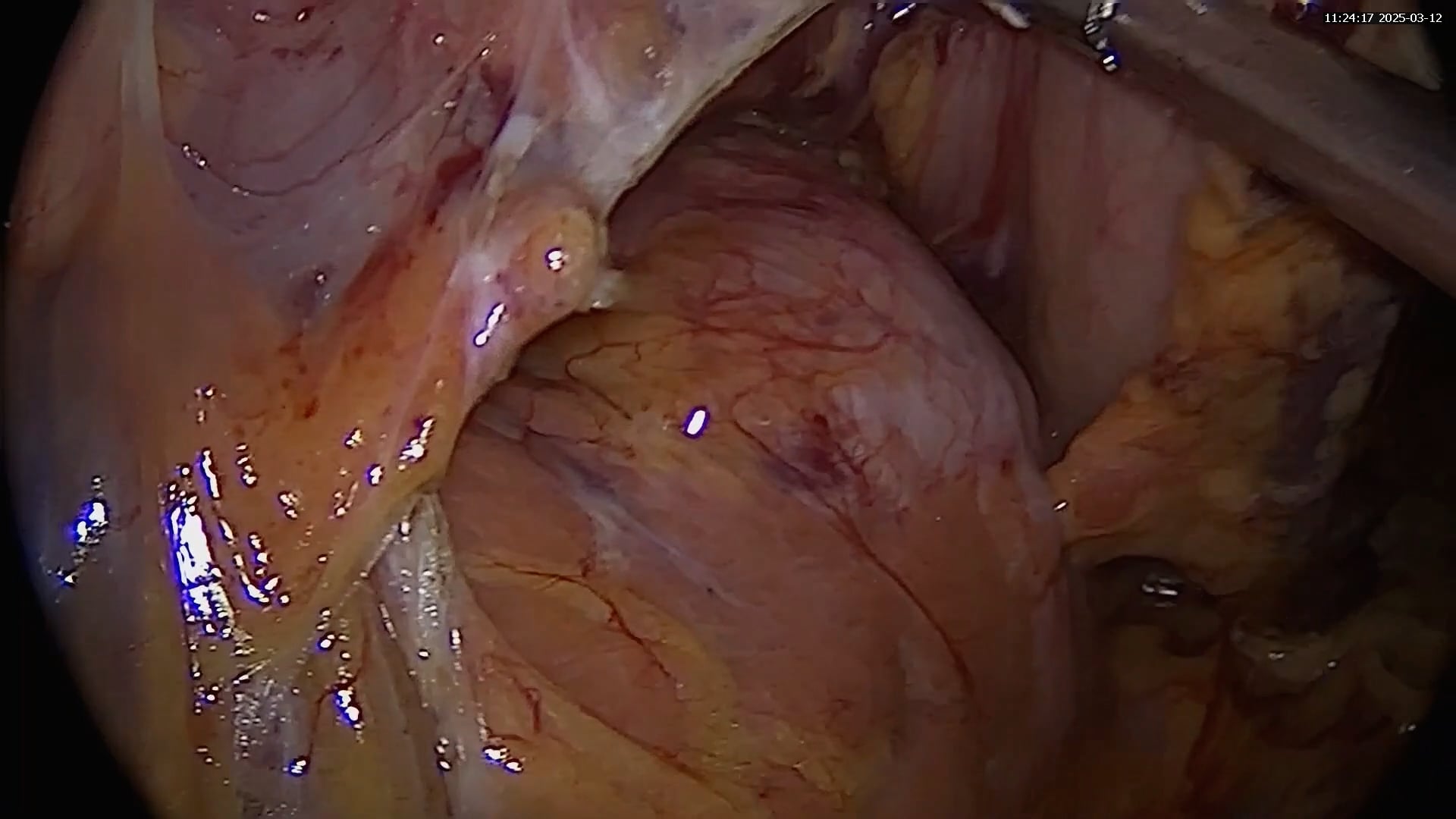 Laparoscopic distal pancreatectomy with splenectomy complicated by complete common hepatic artery transection: management of a major vascular injury