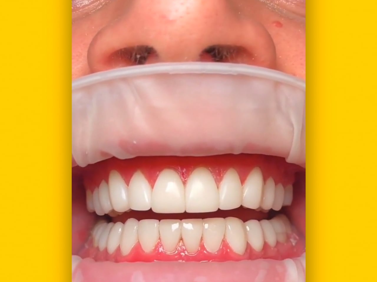 3D Veneers Campaign 9x16 Same Day