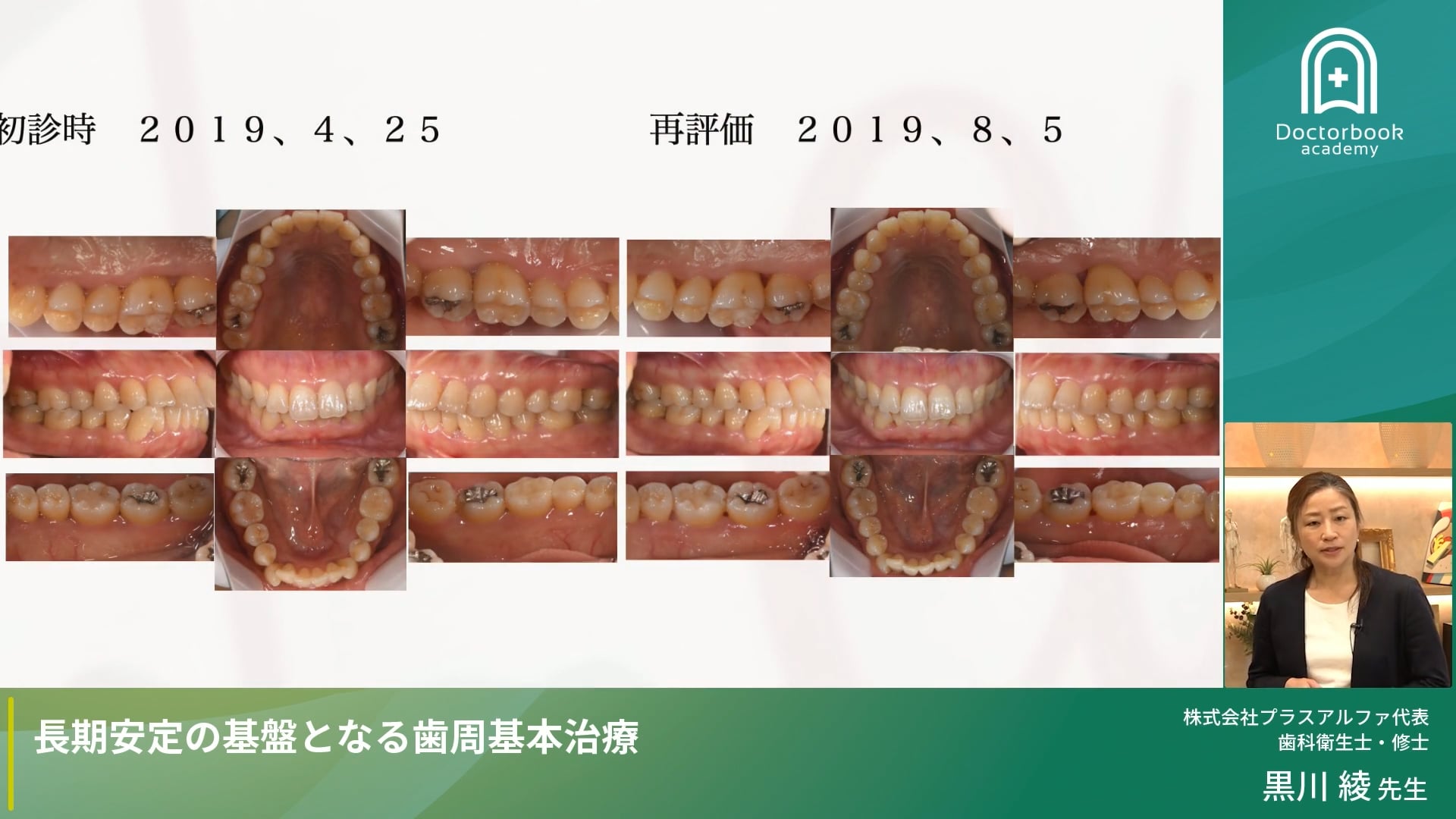 長期安定の基盤となる歯周基本治療