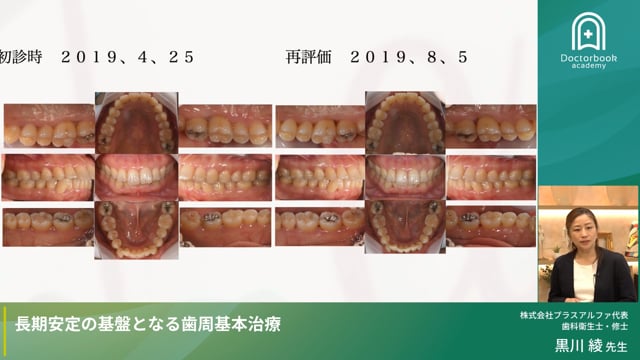 長期安定の基盤となる歯周基本治療