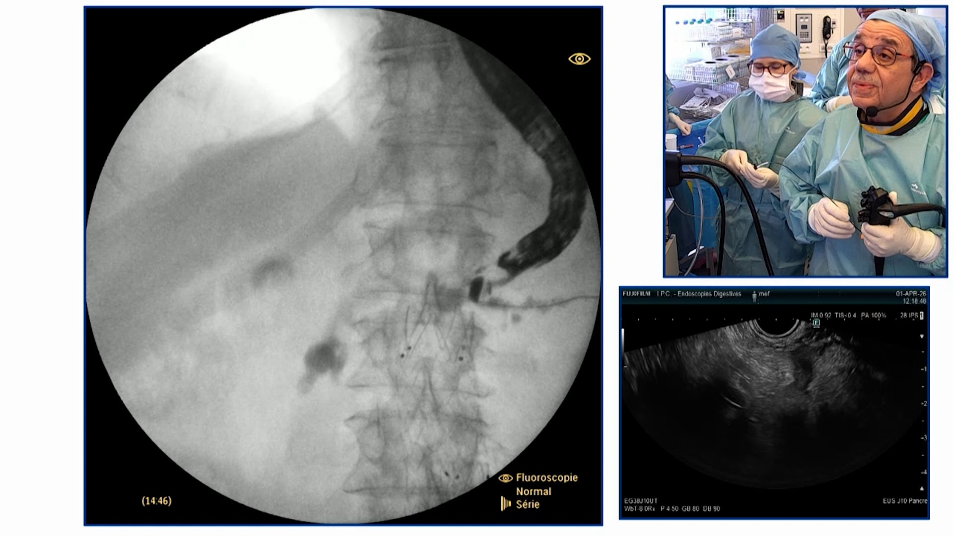 EUS-guided pancreaticogastrostomy for chronic pancreatitis