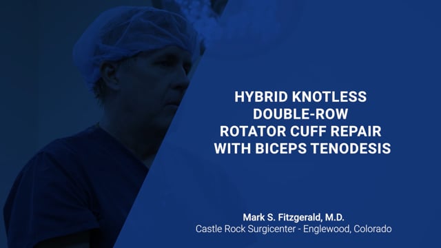Hybrid knotless double-row rotator cuff repair and biceps tenodesis using the X-Twist™ Fixation System