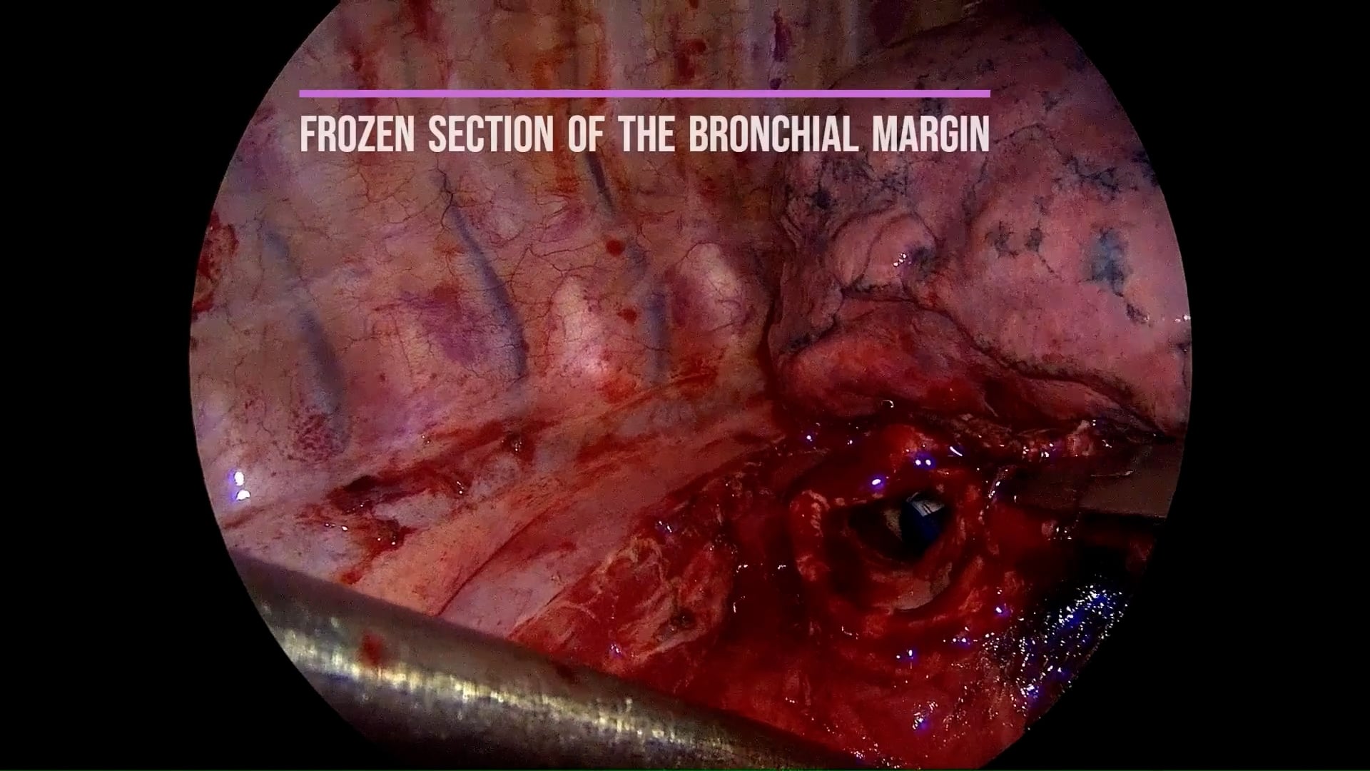 Minimally invasive right lower lobectomy with bronchoplasty for central squamous cell carcinoma: a video case report