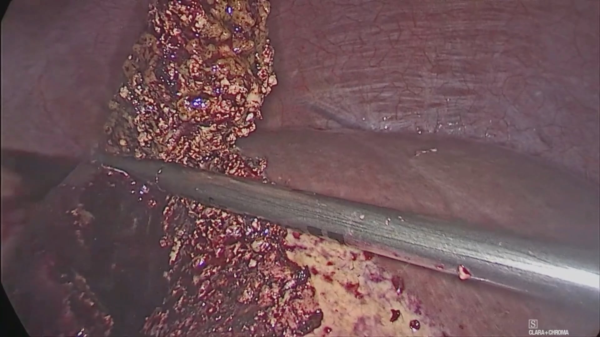 Simultaneous laparoscopic right hemicolectomy and laparoscopic liver metastasectomy with endoscopic ultrasound guidance due to liver metastatic colon cancer