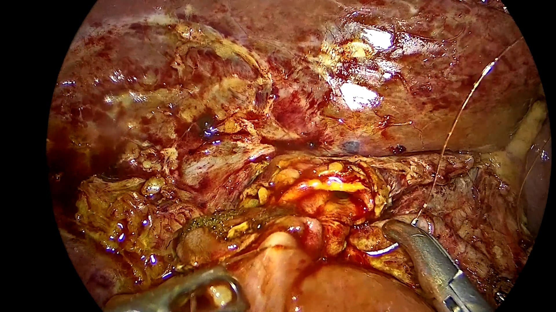 Laparoscopic pancreatoduodenectomy (Whipple procedure) with Roux-en-Y reconstruction for pancreatic adenocarcinoma