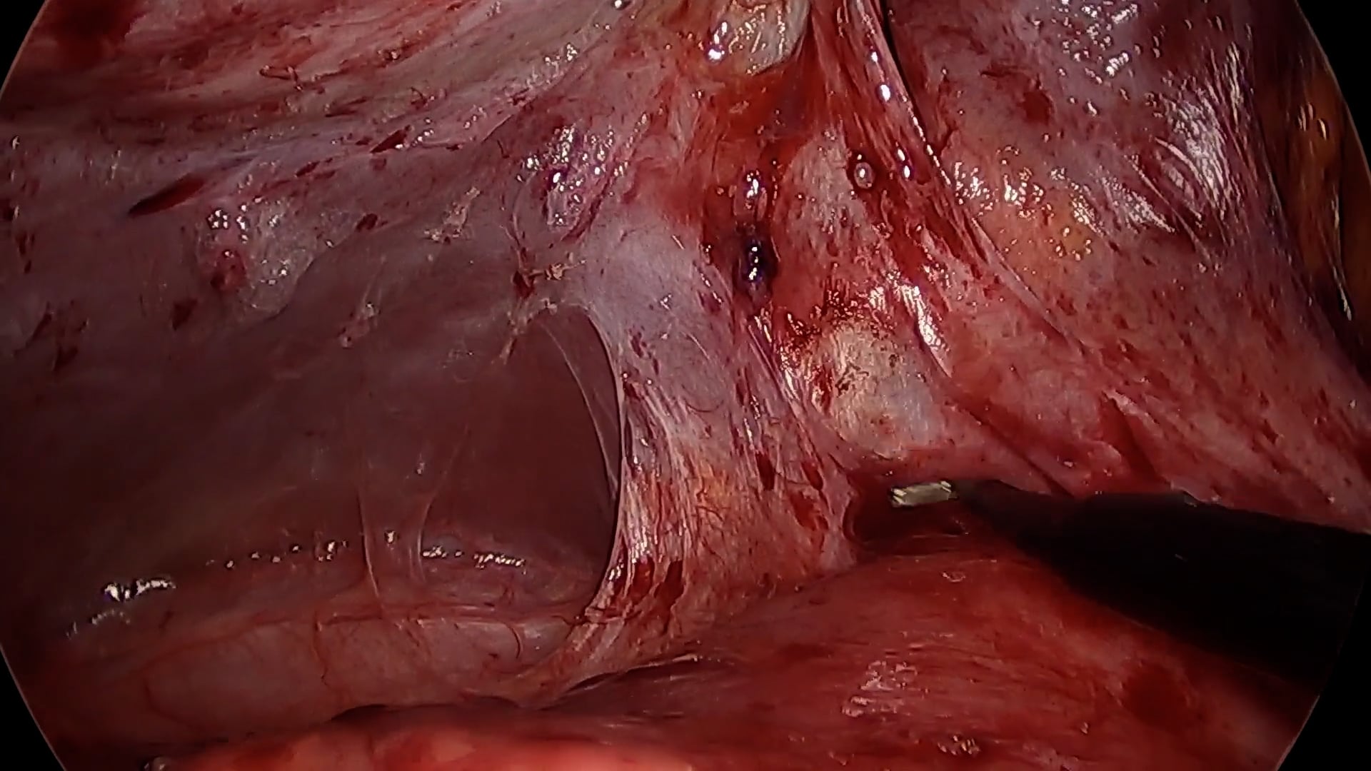 Laparoscopic cholecystectomy after severe acute pancreatitis: a technical challenge