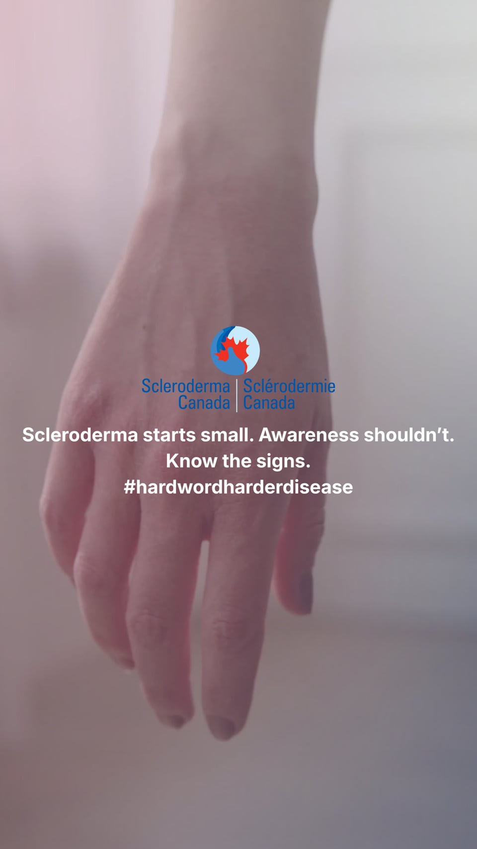 Scleroderma: More Than You Can See - What is Raynaud's?