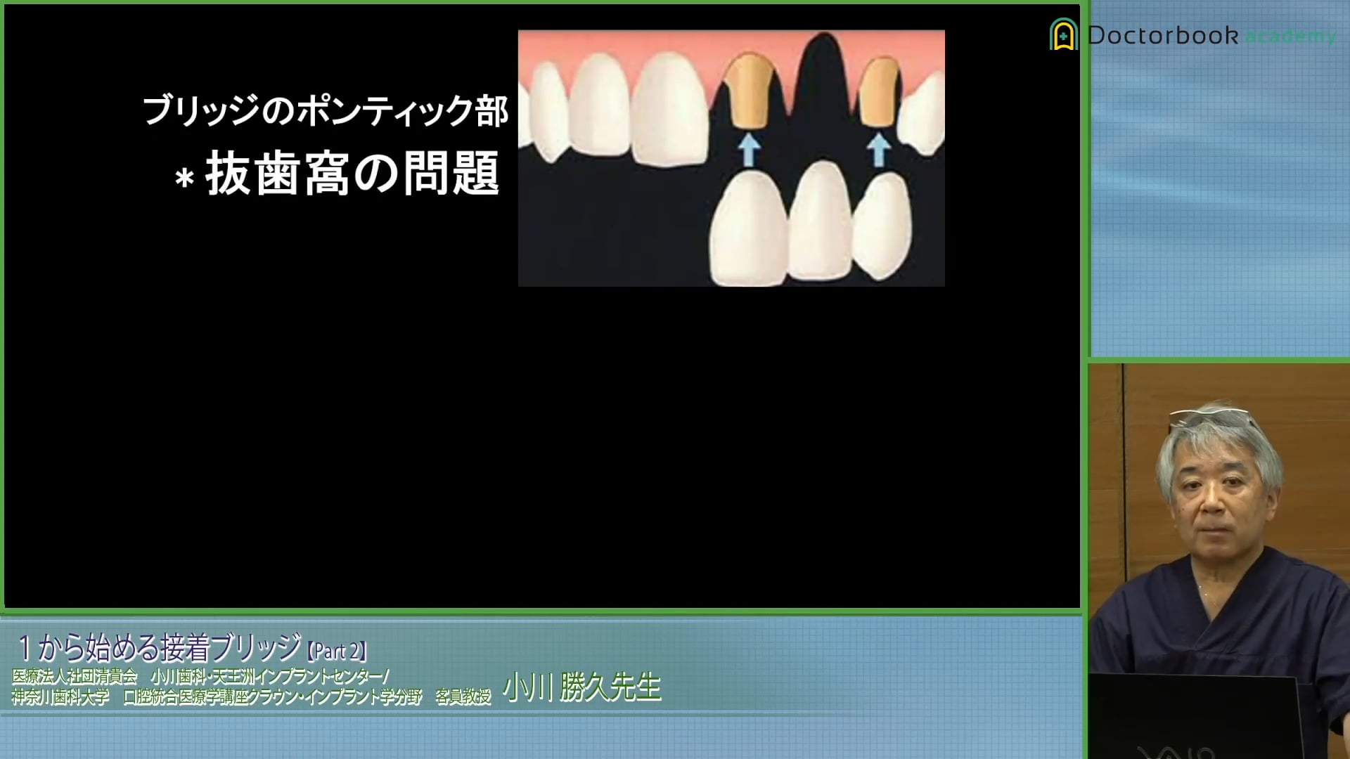 臨床知見録_接着ブリッジ_抜歯後変化を見越した診断