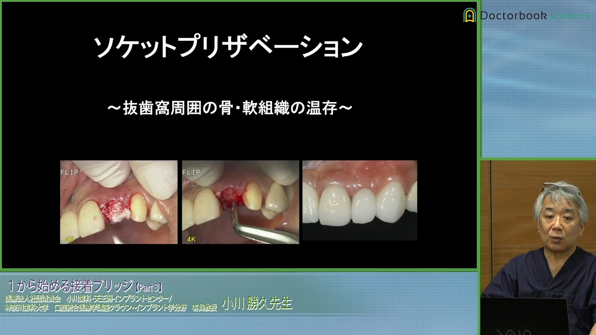 臨床知見録_接着ブリッジ_ソケットプリザベーションの適応