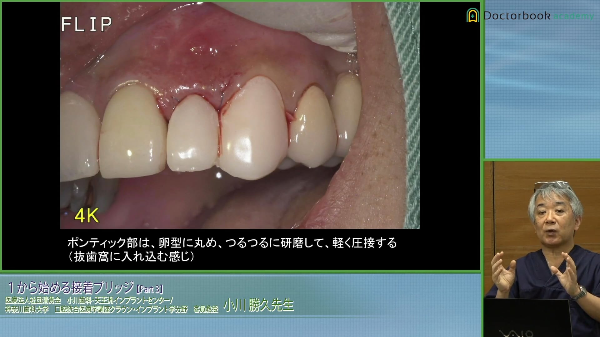 臨床知見録_接着ブリッジ_テンポラリーによる軟組織管理