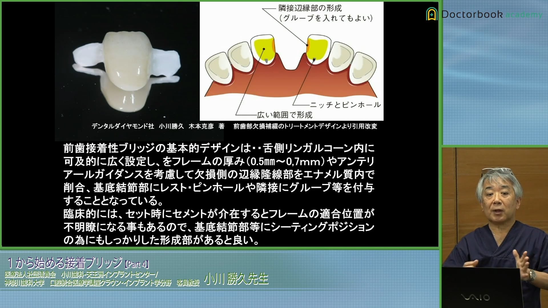 臨床知見録_接着ブリッジ_リテーナーとウイングの基本設計