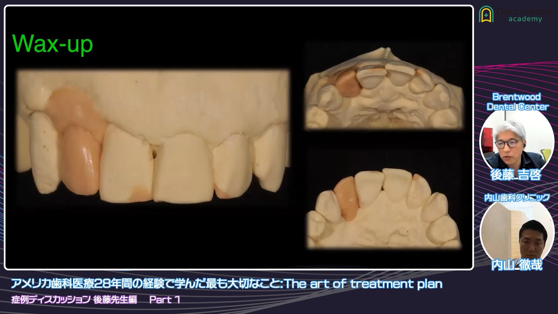 臨床知見録_接着ブリッジ_人工歯肉を含む補綴設計