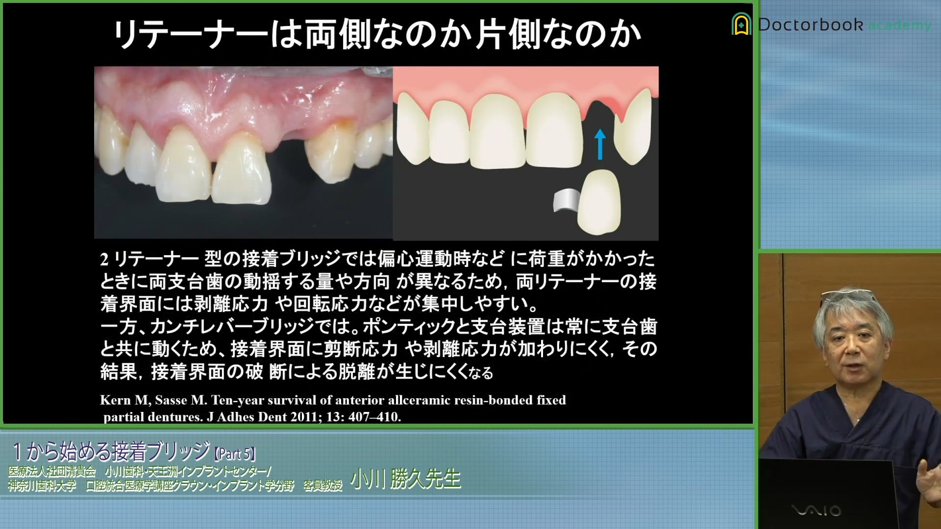 臨床知見録_接着ブリッジ_片側支台と両側支台の考え方
