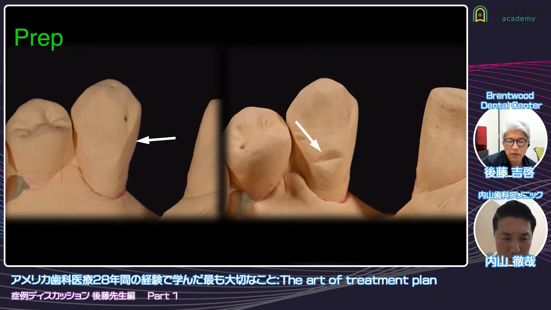 臨床知見録_接着ブリッジ_最小限形成の設計
