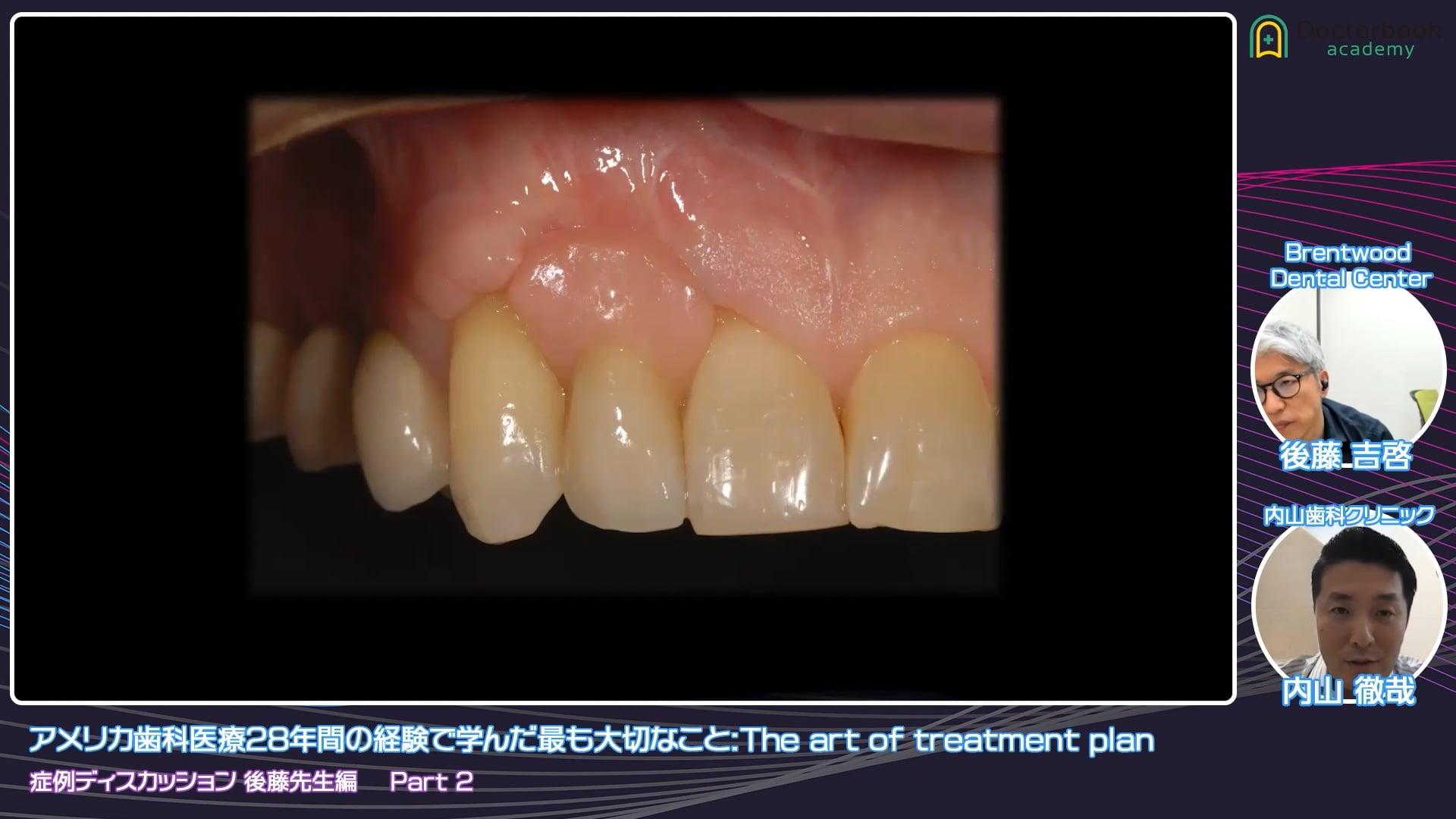 臨床知見録_接着ブリッジ_ジルコニア接着の基本原理