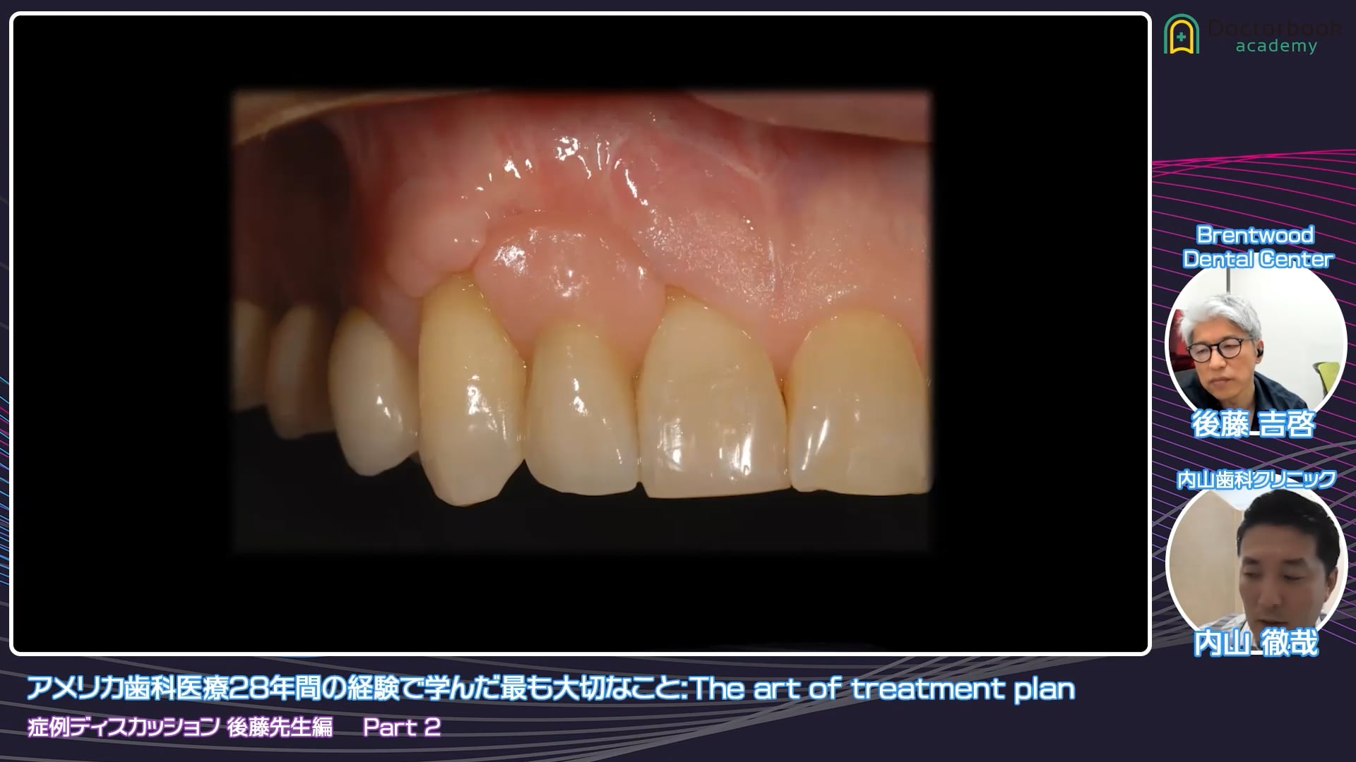 臨床知見録_接着ブリッジ_材料ごとの特徴と使い分け
