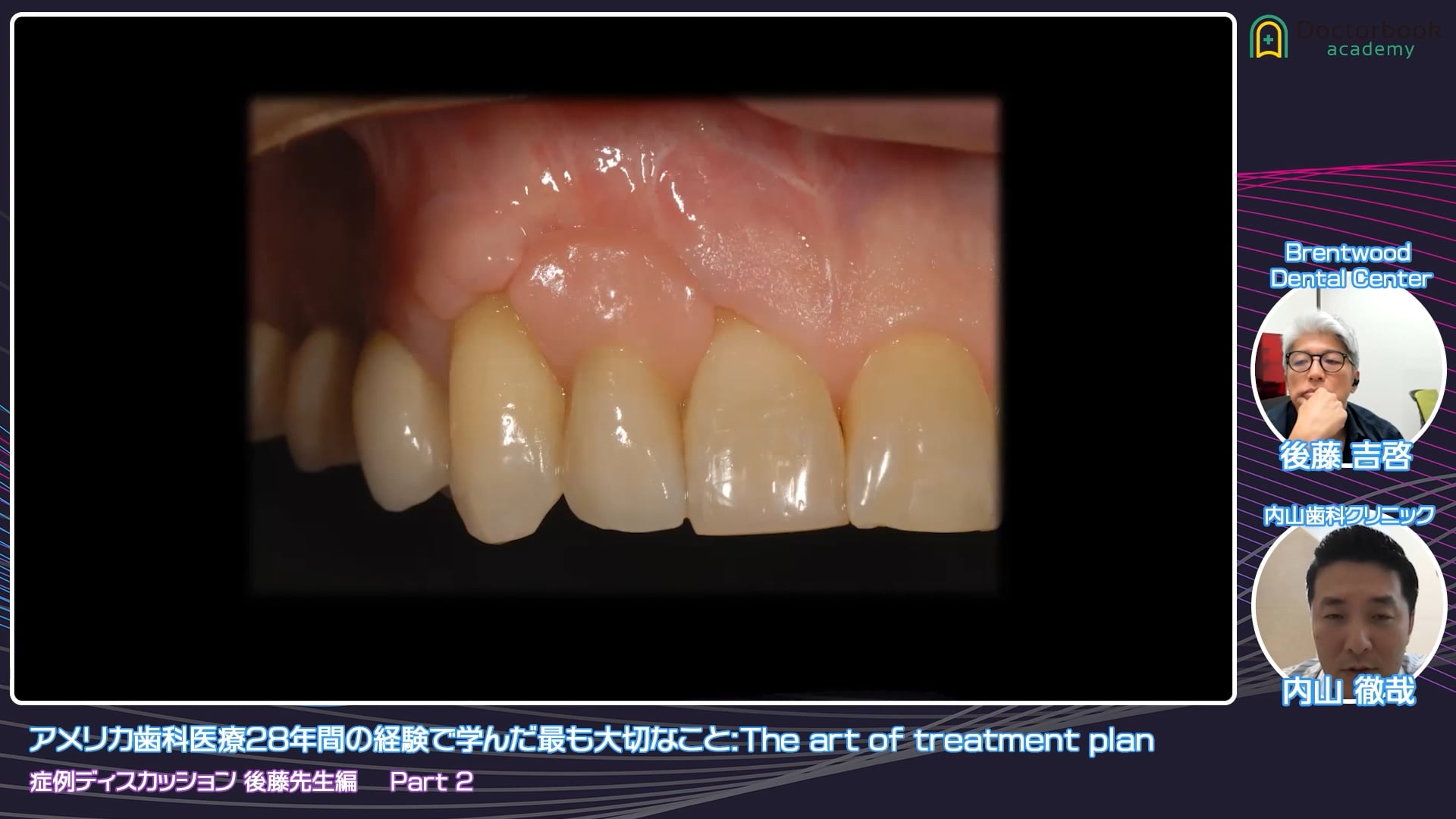 臨床知見録_接着ブリッジ_メタル接着の前処理と接着材