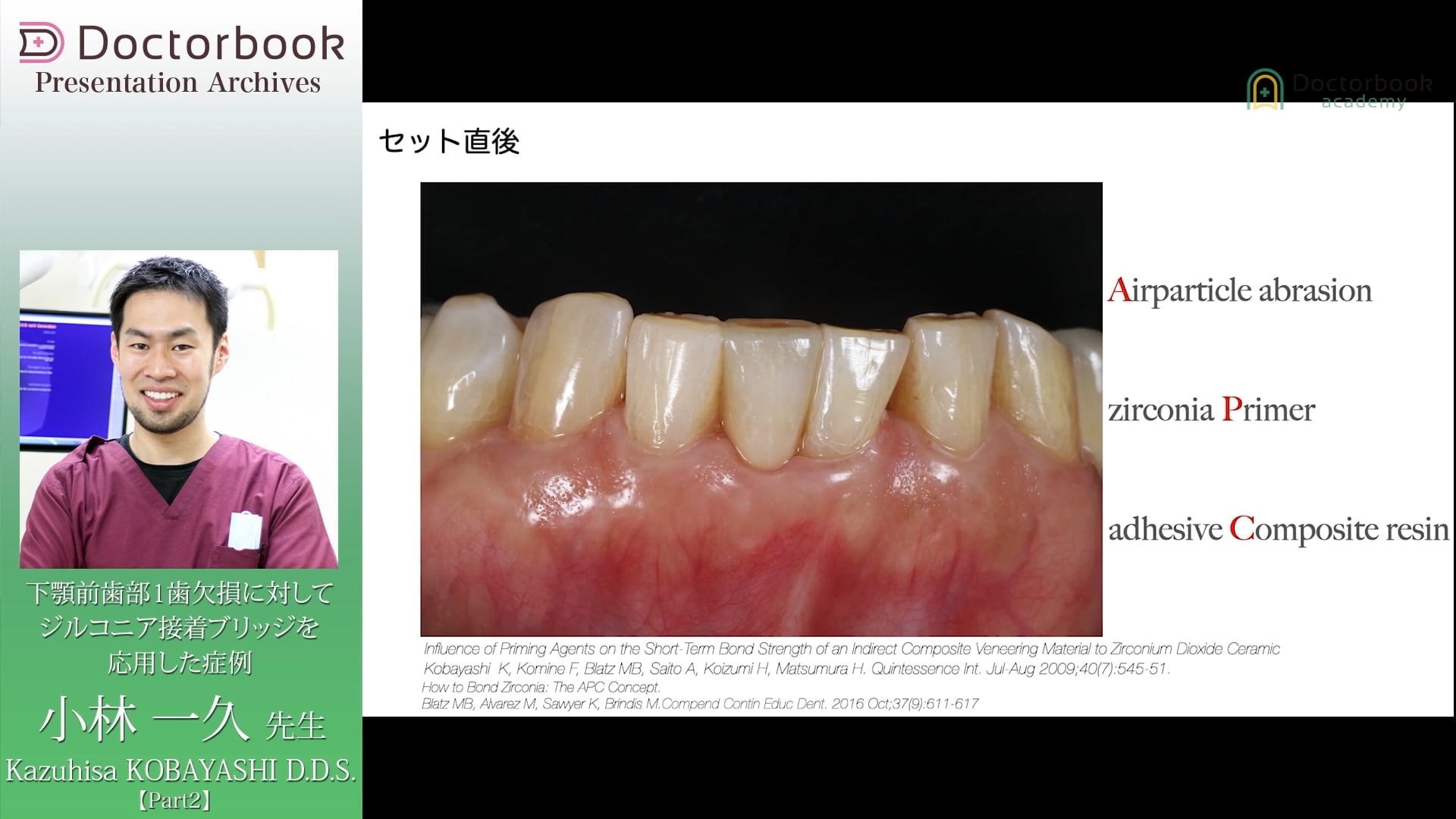 臨床知見録_接着ブリッジ_装着直後の評価ポイント