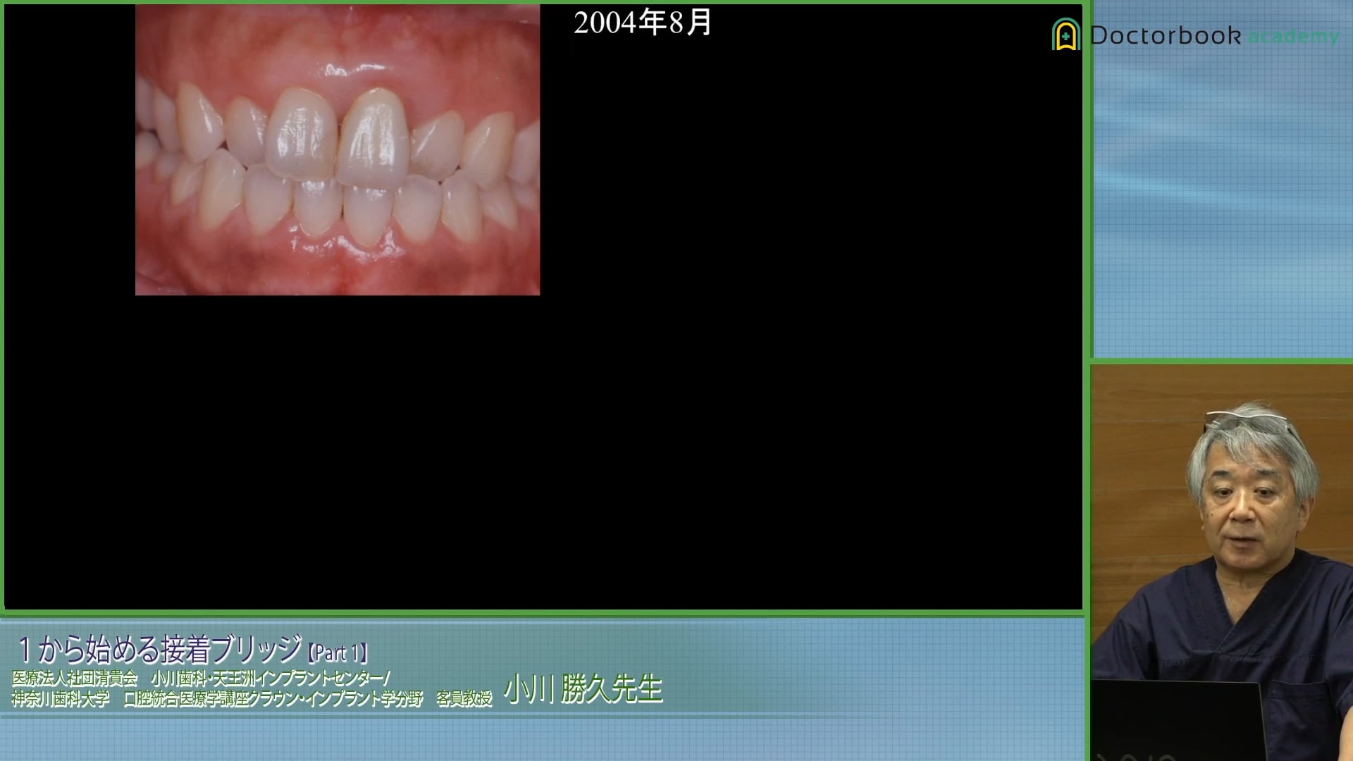 臨床知見録_接着ブリッジ_長期経過からみる予後