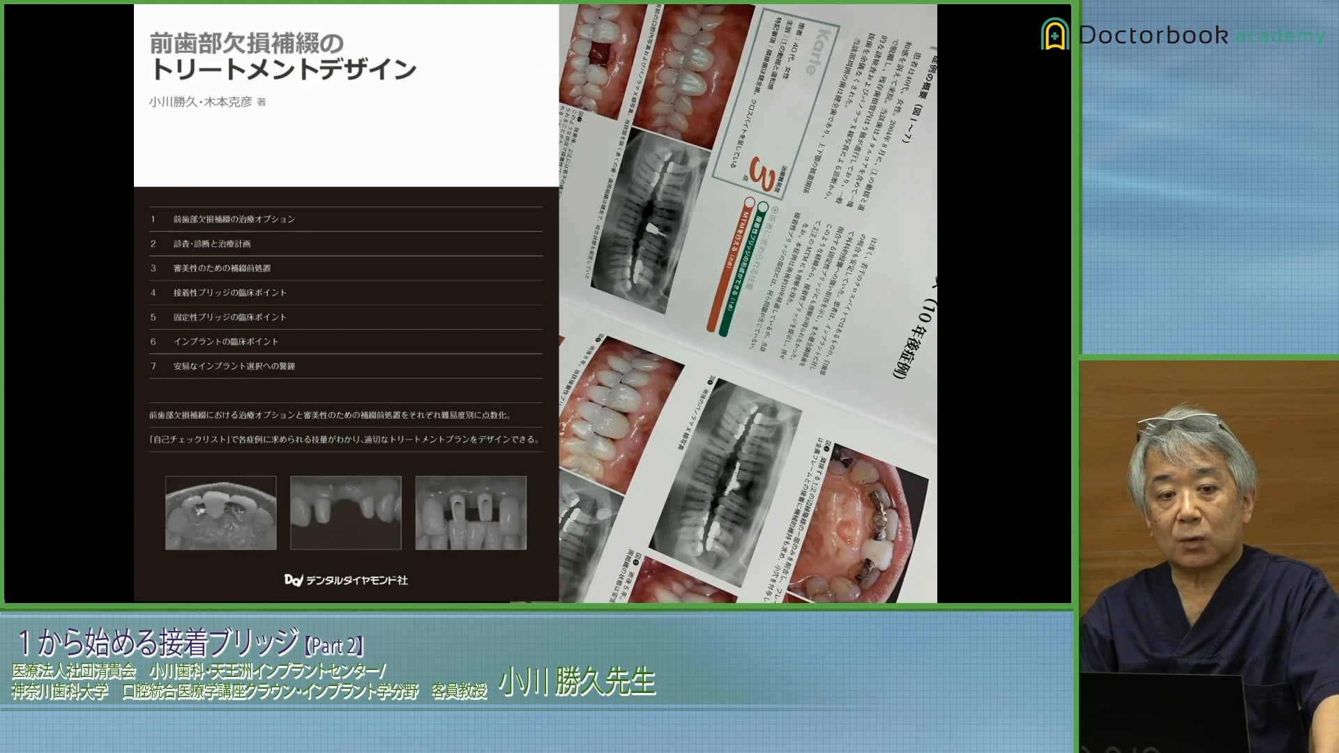  臨床知見録_接着ブリッジ_長期経過症例を学ぶ文献