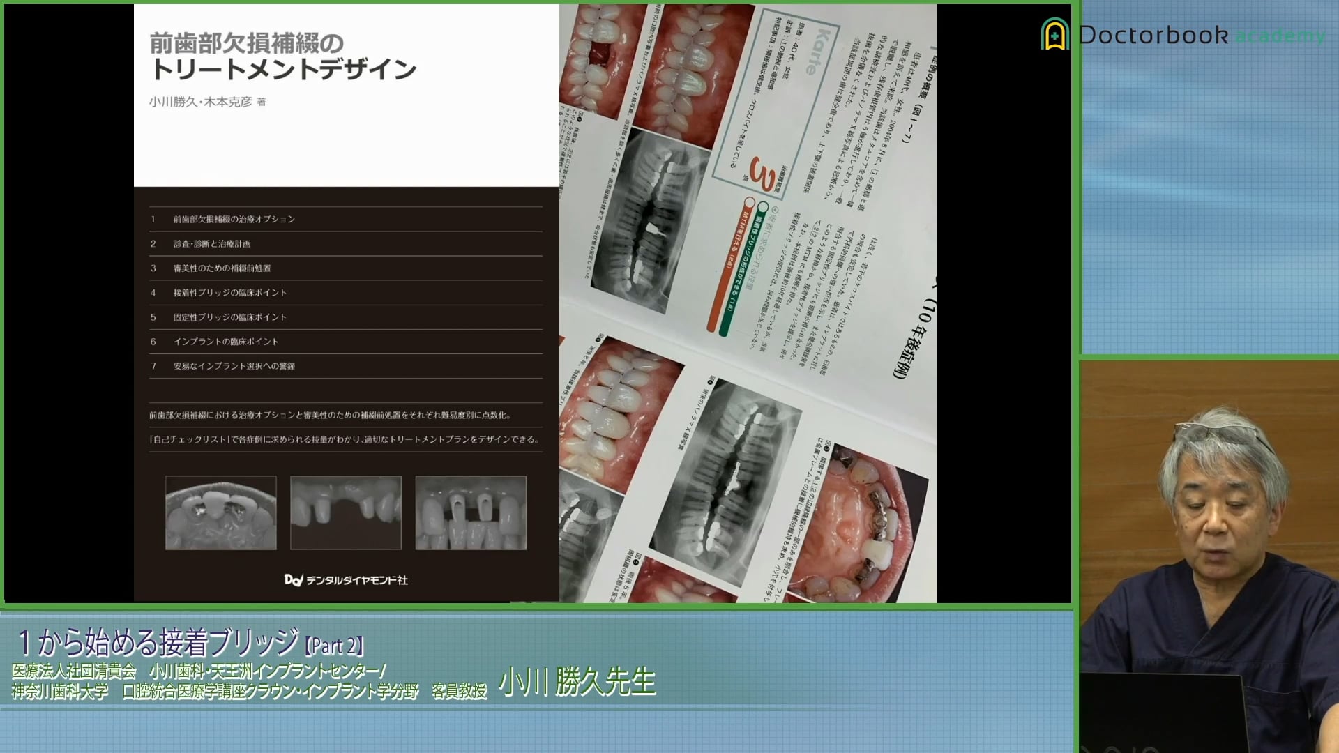 臨床知見録_接着ブリッジ_金属接着に用いる接着材