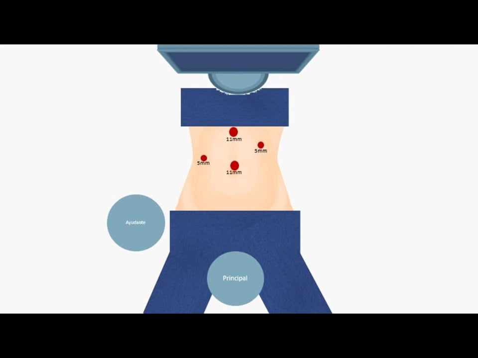 Abordaje mínimamente invasivo de la hernia diafragmática traumática no aguda secundaria a traumatismo cerrado: serie de cuatro casos y revisión de la literatura.
