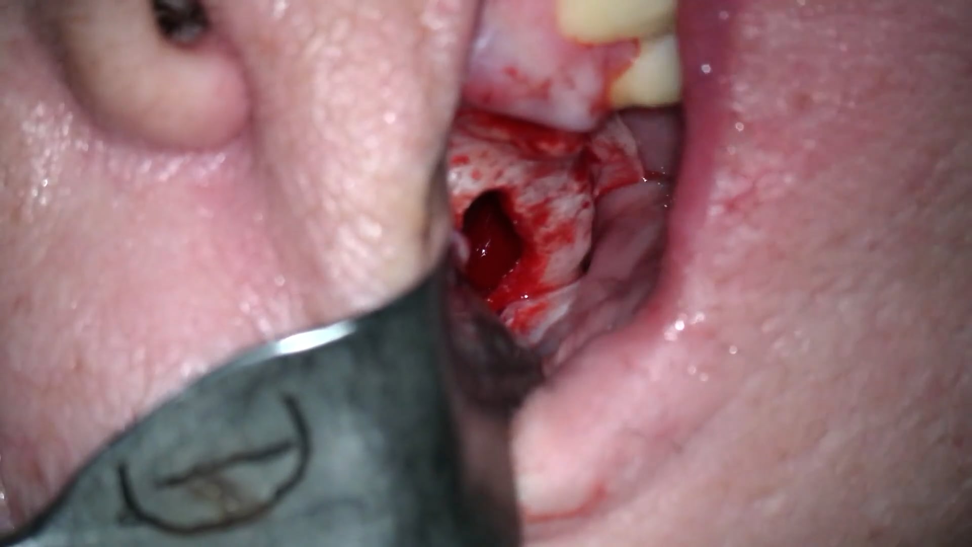 Colocación de implantes en 1.5 y 1.7 pterigoideo abriendo ventana del seno para elevar entorno respecto a este