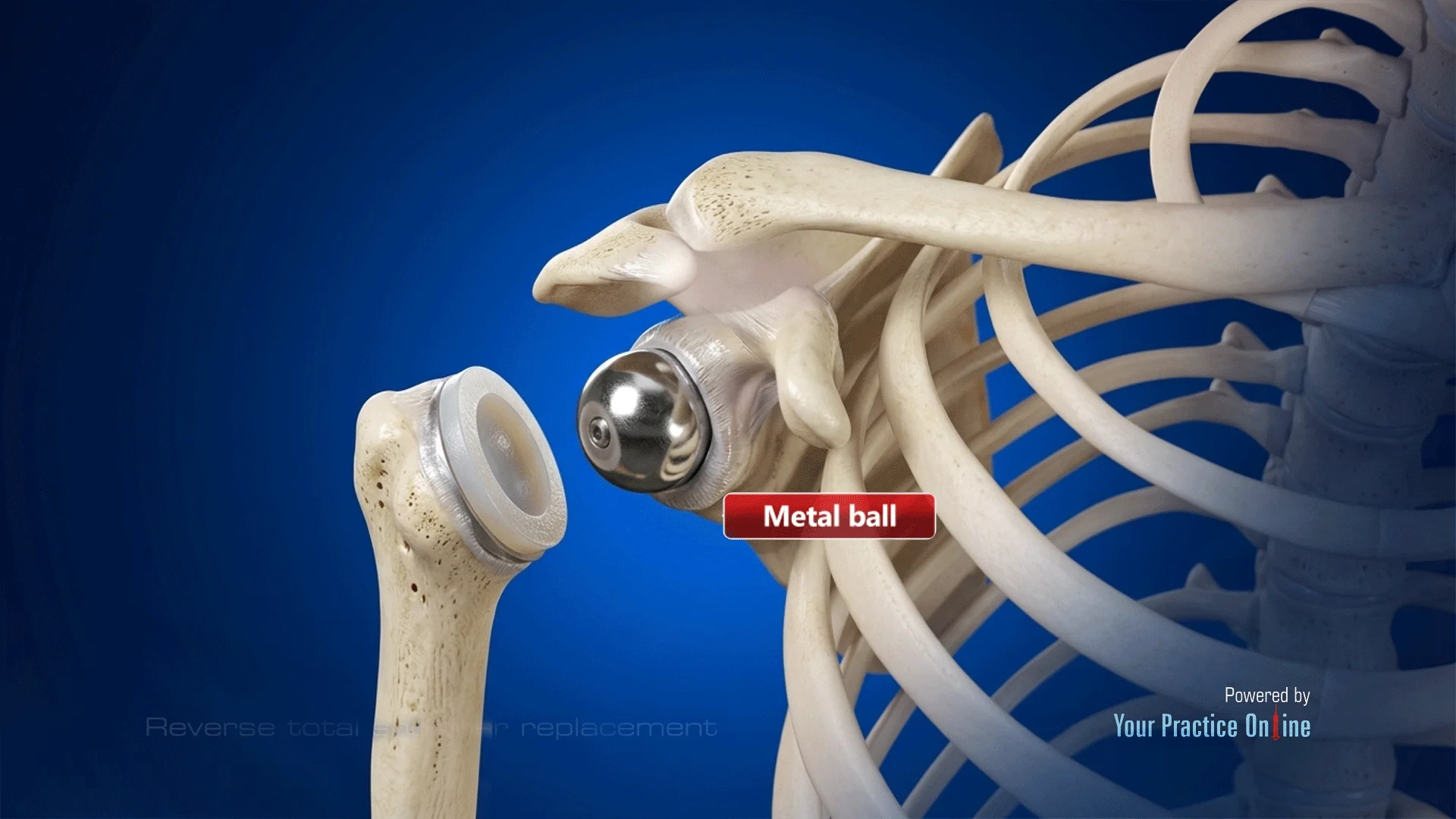 Reverse Shoulder Replacement Phoenix, AZ | Rotator cuff Repair
