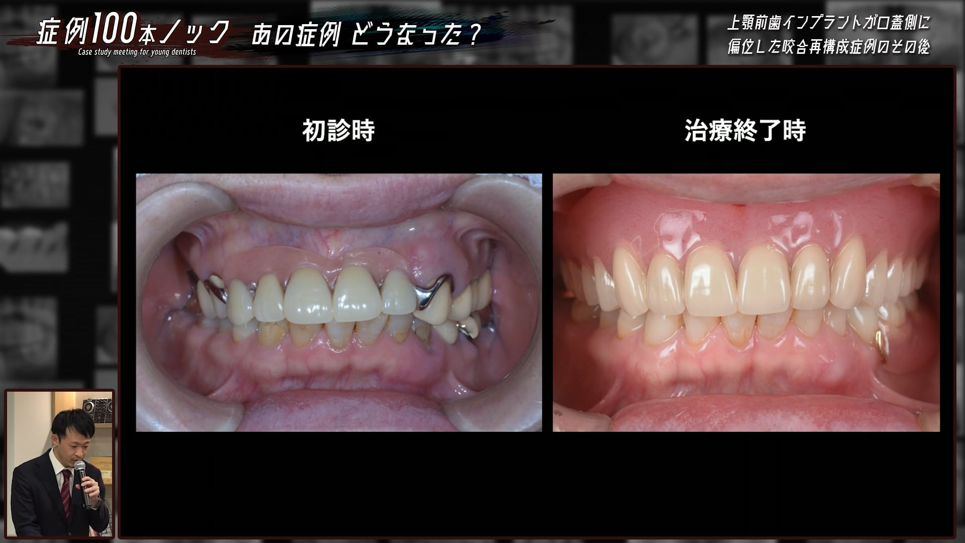 高野 光司先生 ～多数歯欠損症例の最終補綴と治療計画を振り返る