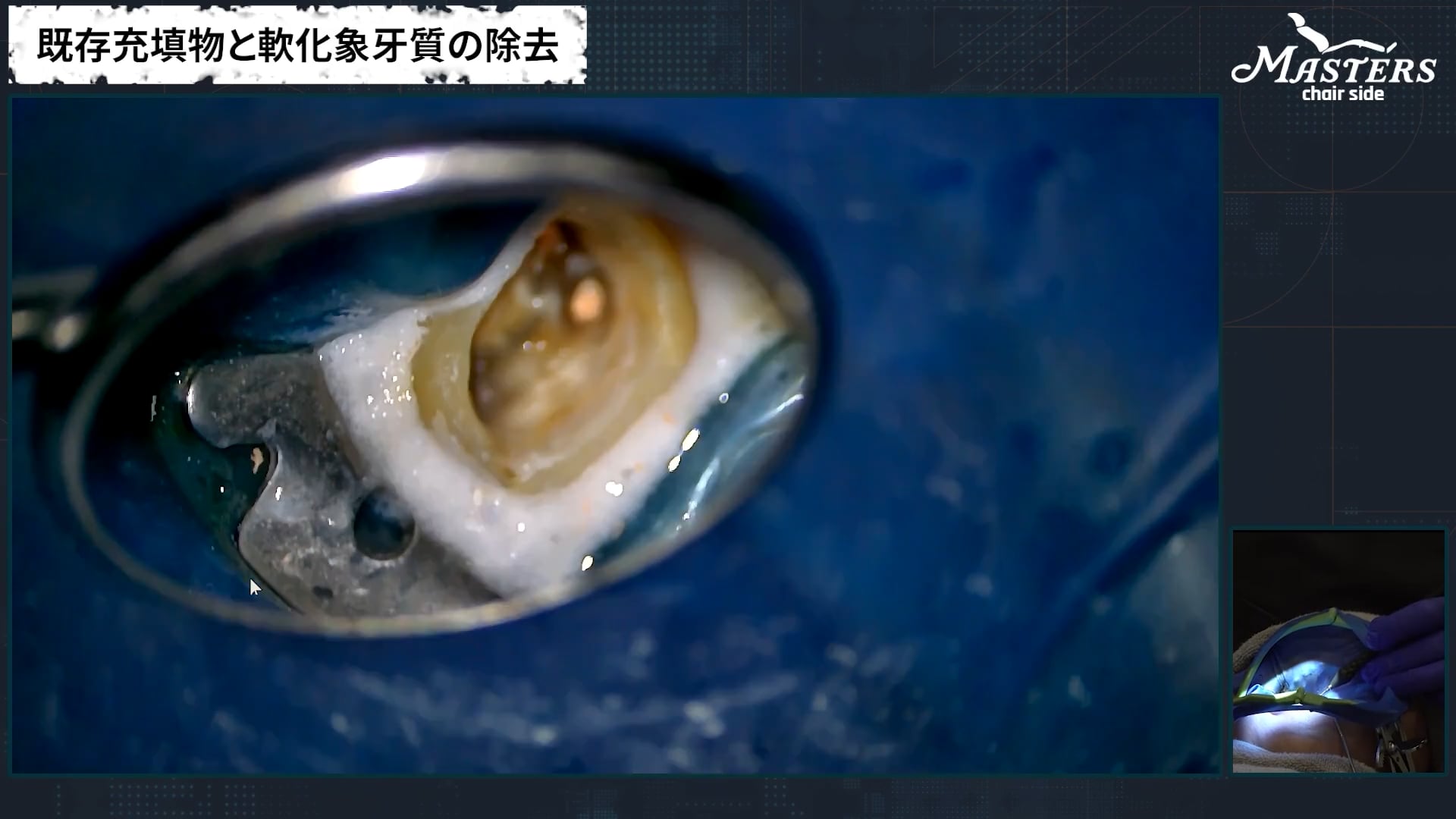 Part2 隔壁形成・根管長測定・根管形成の実際