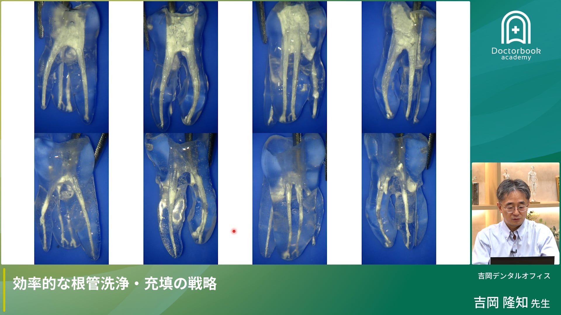 効率的な根管洗浄・充填の戦略